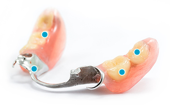 ¿Qué son las prótesis dentales removibles parciales?