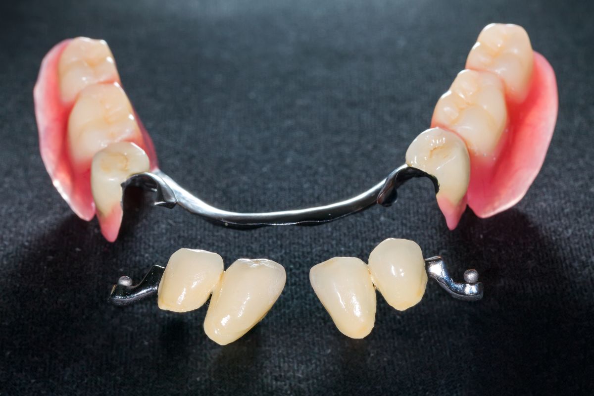 Prótesis de dientes postizos.