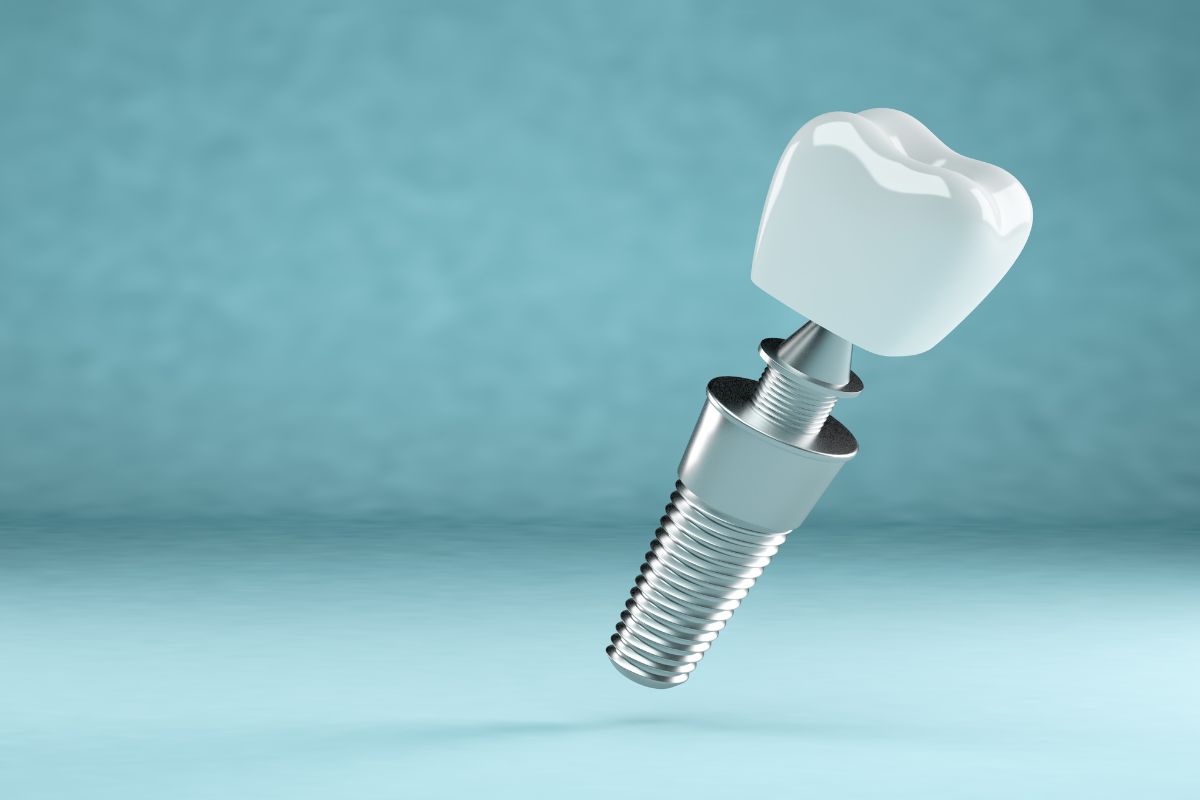 Proceso completo para colocar implantes dentales