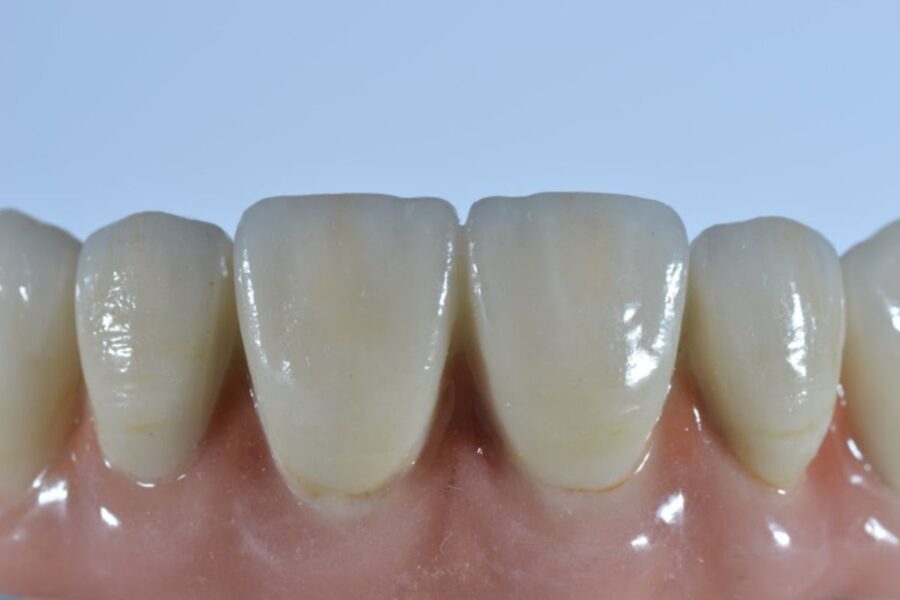 Lo último en Prótesis Dentales Removibles - Laborprothesis