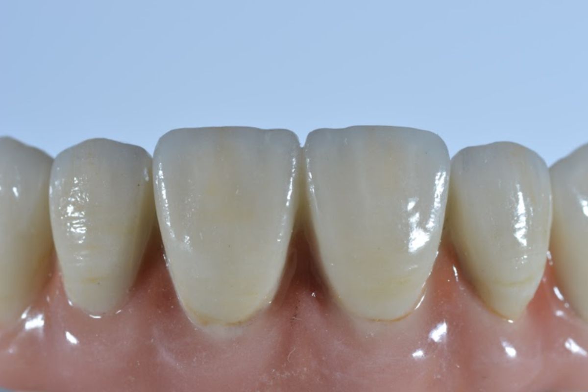 Lo último en prótesis dentales removibles