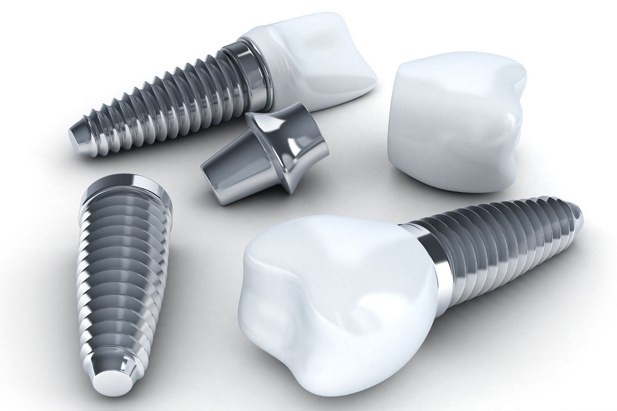 Guía completa sobre prótesis dentales