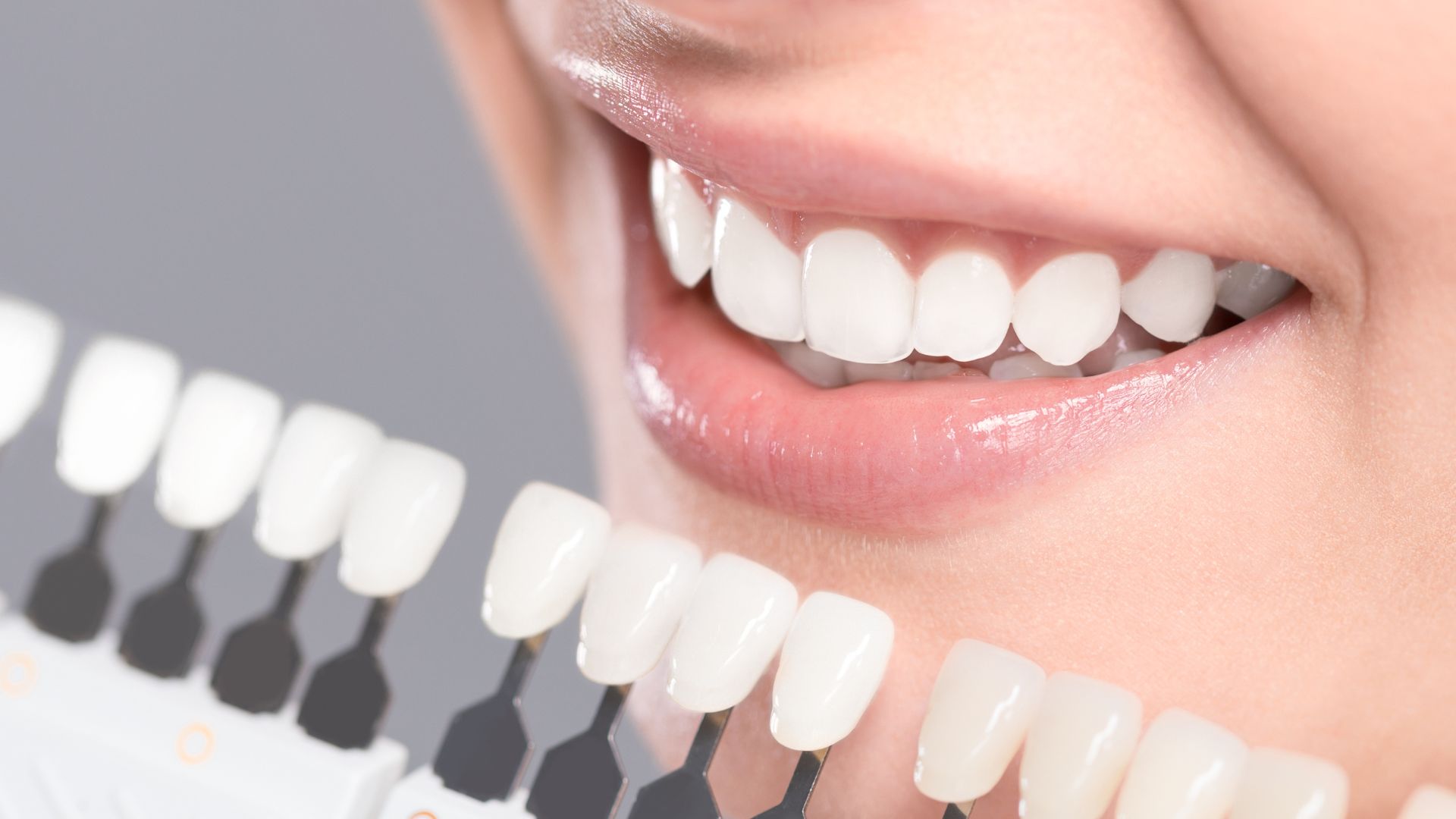 ¿Qué son los dientes provisionales y qué tipos existen?