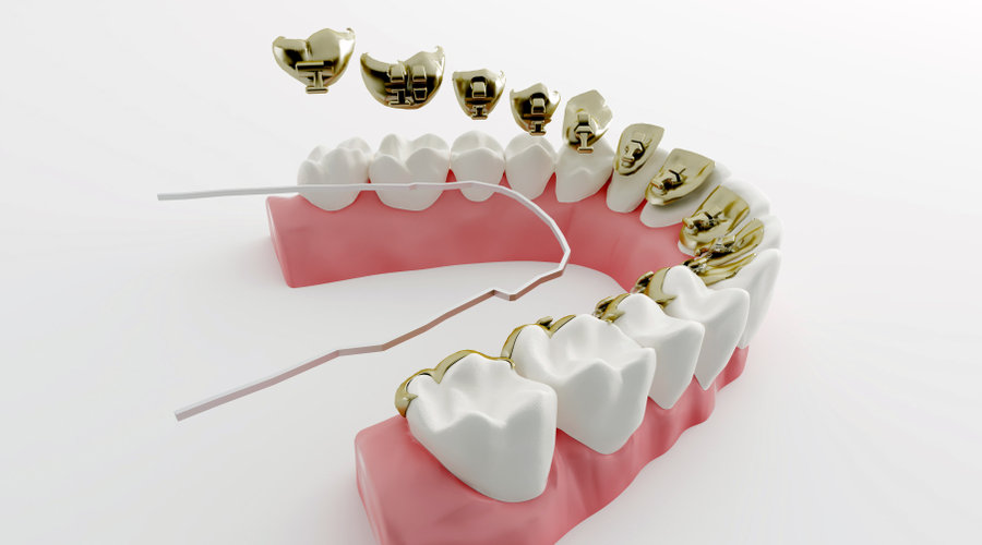 Impresión 3D en odontología: Innovación y aplicaciones