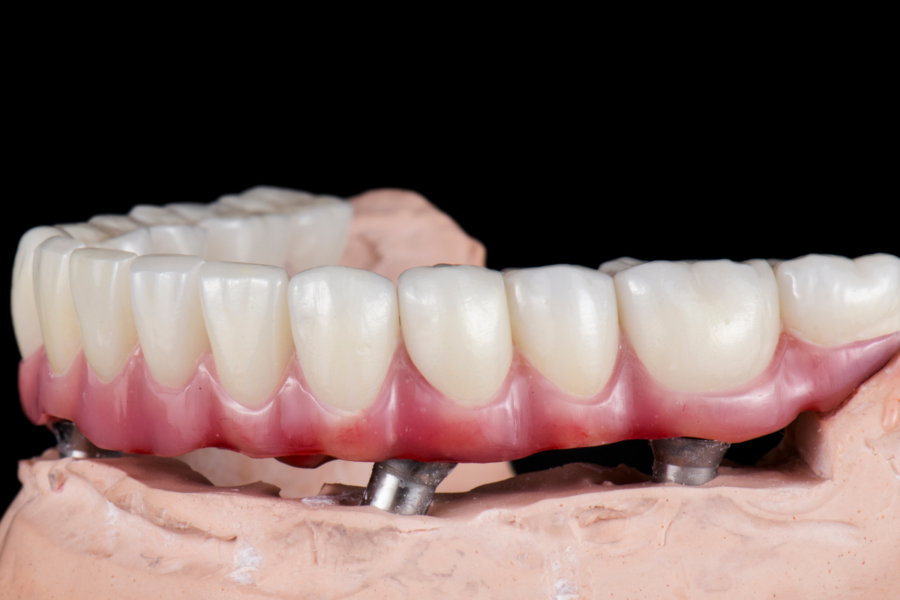 Prótesis dentales híbridas: La solución innovadora para la restauración dental - Laborprothesis