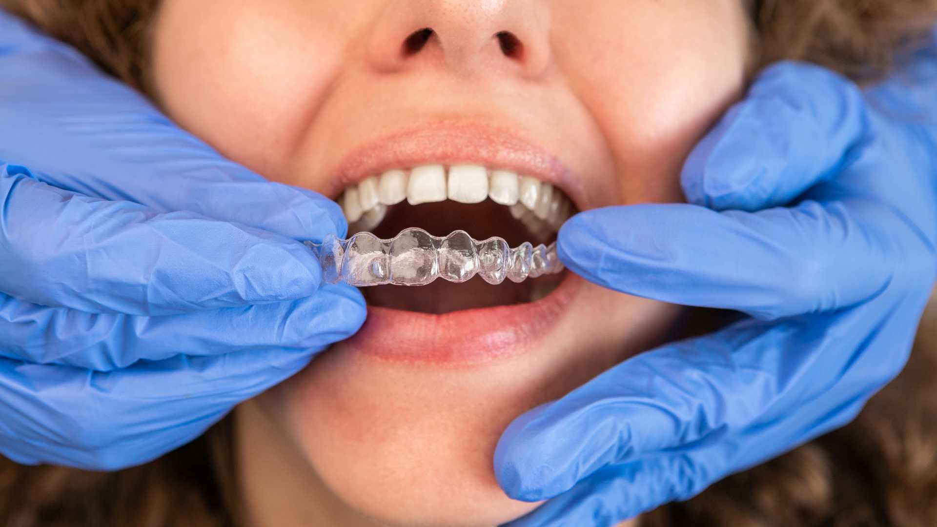 Retenedores dentales: la clave para una sonrisa perfecta