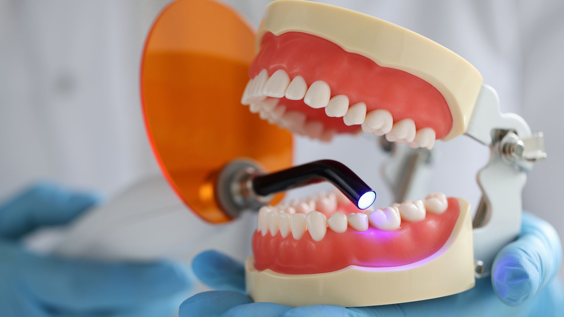 Incrustaciones dentales: solución duradera para dientes dañados
