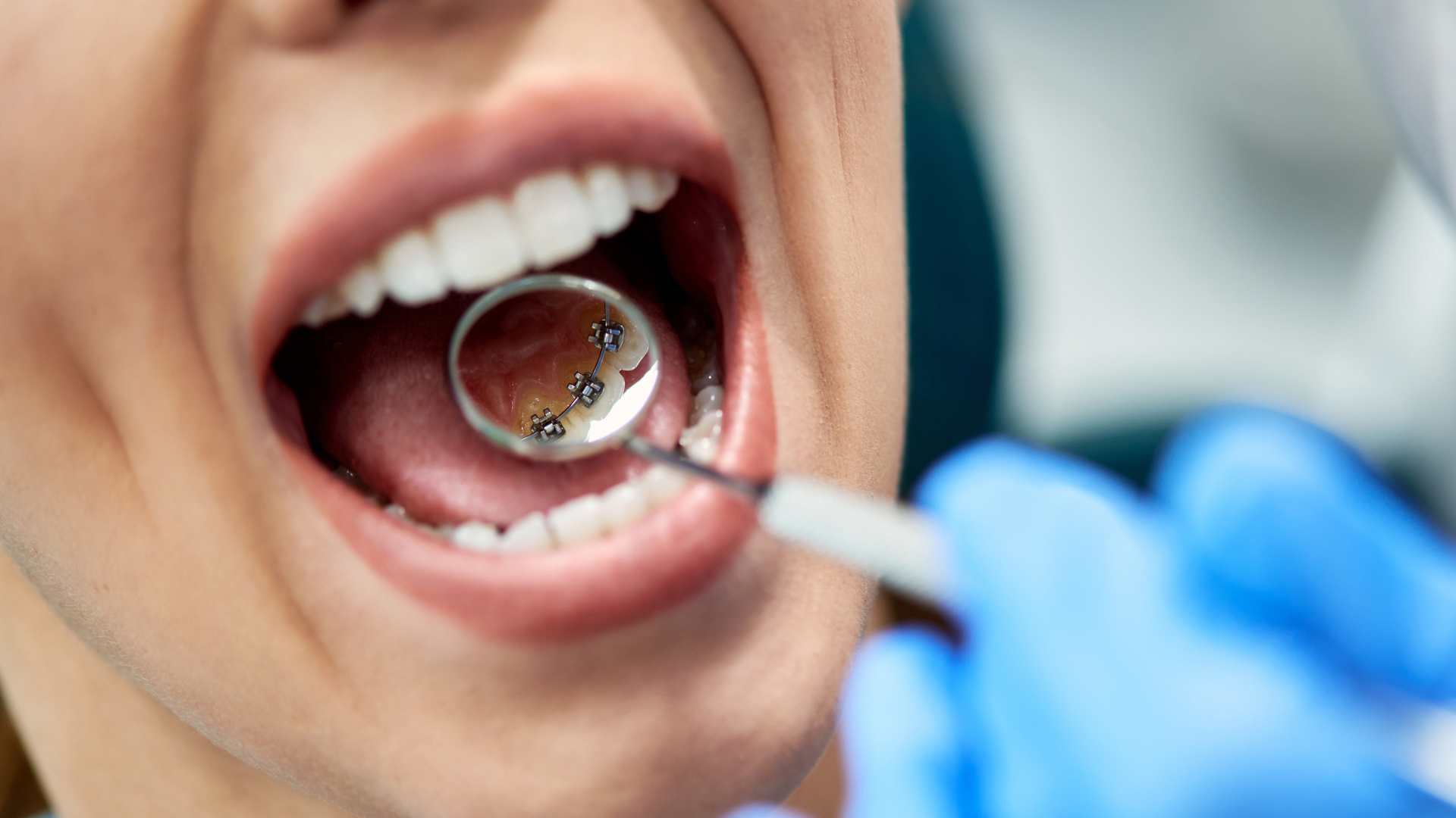 Ortodoncia lingual: sonrisa perfecta sin que nadie lo note